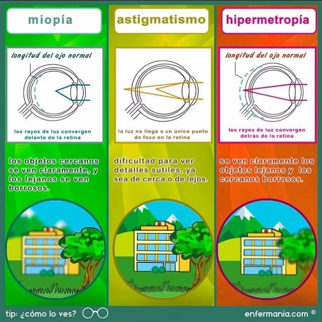 hipermetropía astigmatismo y miopía