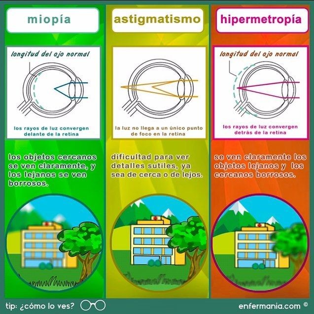 Ce este Astigmatismul: definiție, simptome, diagnostic și tratament